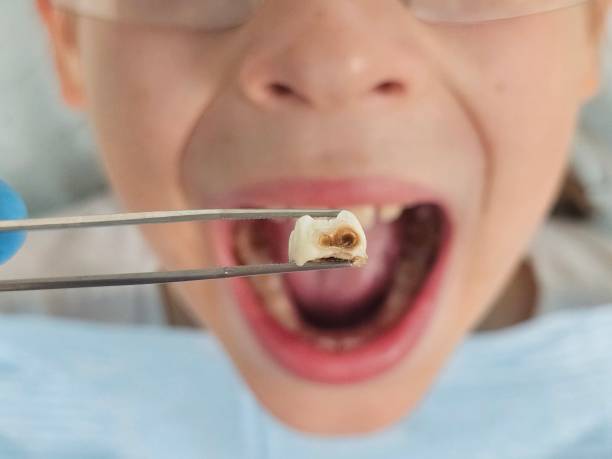 Best Emergency Root Canal Treatment in Mystic, CT