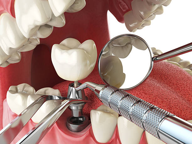 Best Emergency Tooth Extraction in Mystic, CT